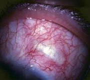 Scleral Spacing Procedure to treat presbyopia, wang vision cataract and LASIK Center